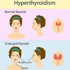 Hyperthyroidism symptoms serumlabs